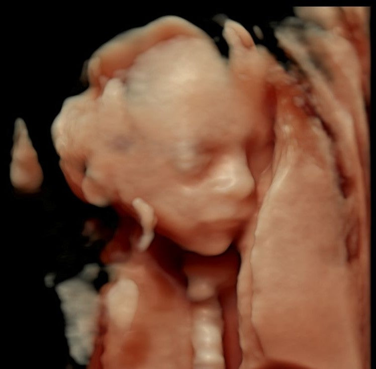 3D ultrasound before EchoEnhance AI ultrasound enhancement